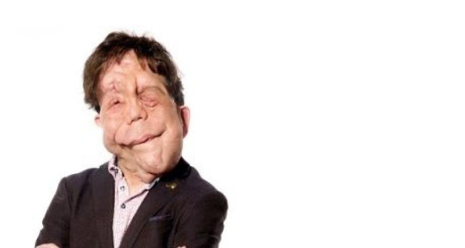 Adam Pearson Says Actors with Disabilities Are Typecast